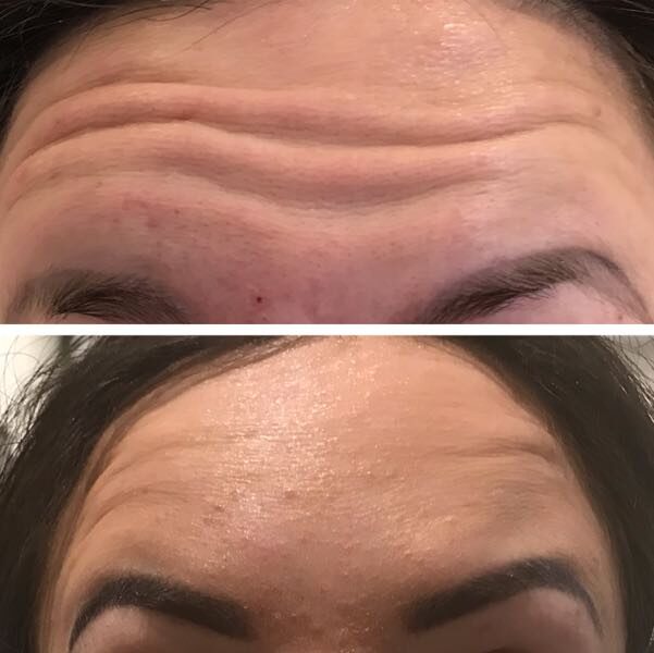 Botox Forehead